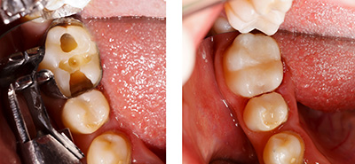 Natural Tooth Colored Fillings