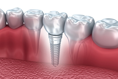 Model of a dental implant